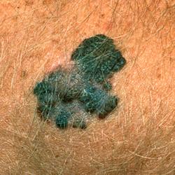 Example of skinCancerAndMelanomas